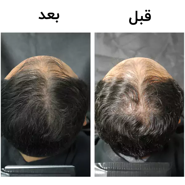 شامپو فیتو ضد ریزش آقایان مدل فیتوسیان PHYTOCYANE